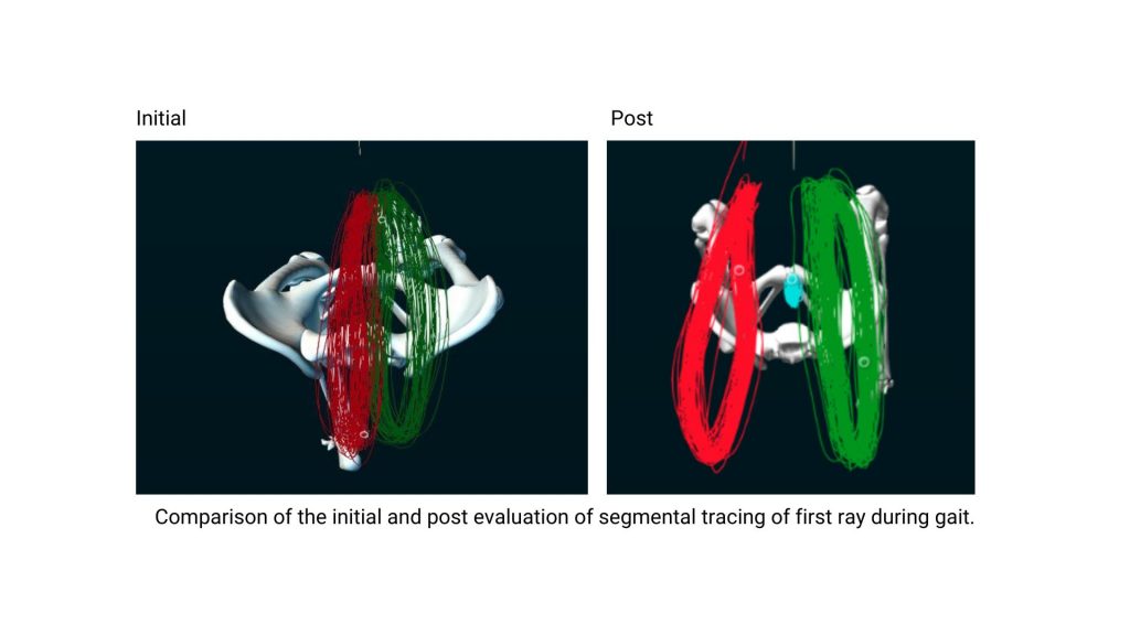 Comparison-of-the-initial-and-post-evaluation-of-segmental-tracing-of-first-ray-during-gait.-1024x576.jpg